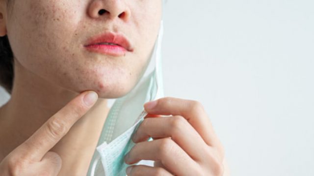 Penyebab Maskne Mask Acne