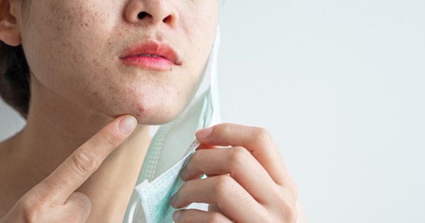 Penyebab Maskne Mask Acne