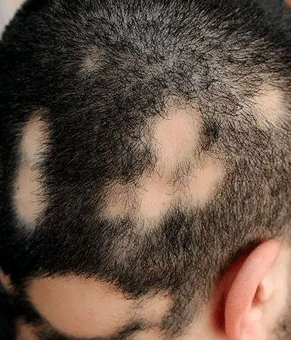 Alopecia Areata