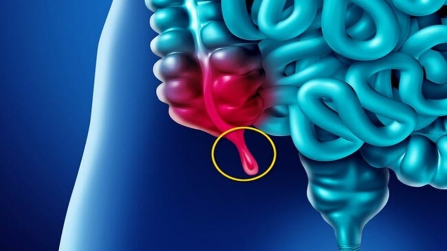 Appendicitis