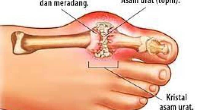 asam urat
