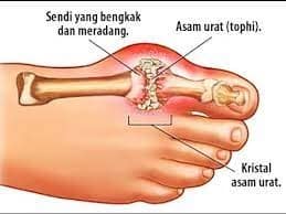 asam urat