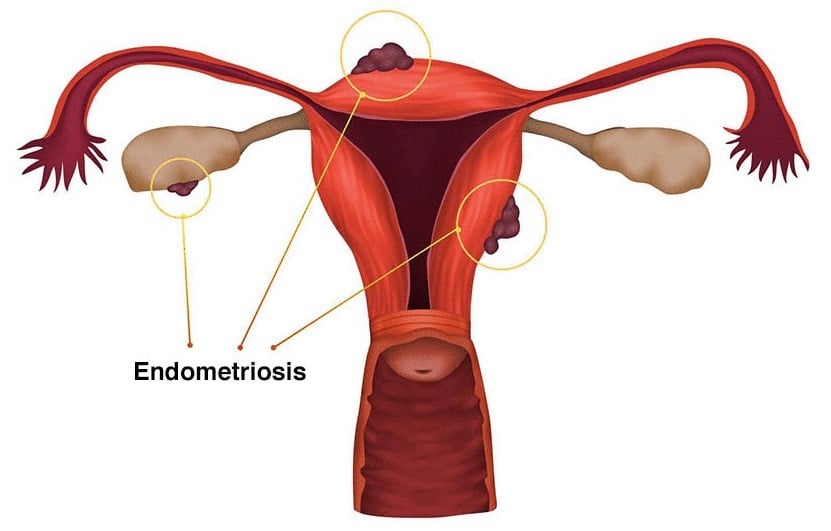 Illustration Endometriosis