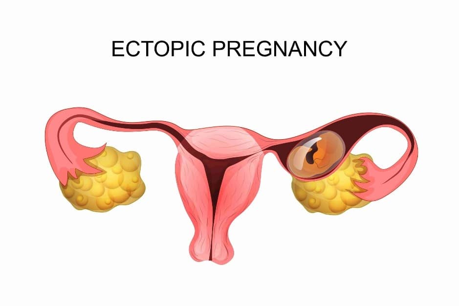 Illustration Etopic Pregnancy