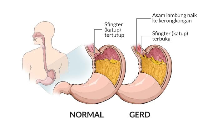 GERD
