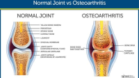 Normal Joint vs Osteoarthritis