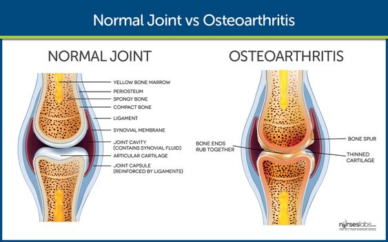 Normal Joint vs Osteoarthritis