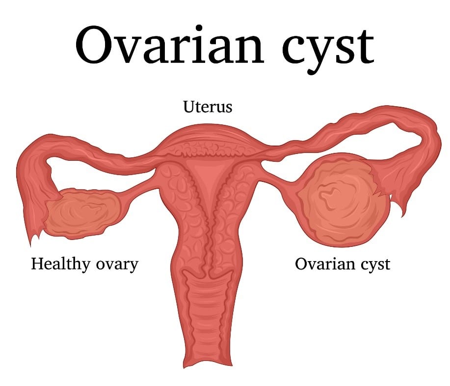 Illustration Ovarian Cyst