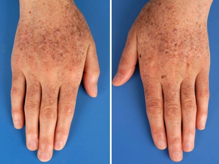 xeroderma pigmentosum