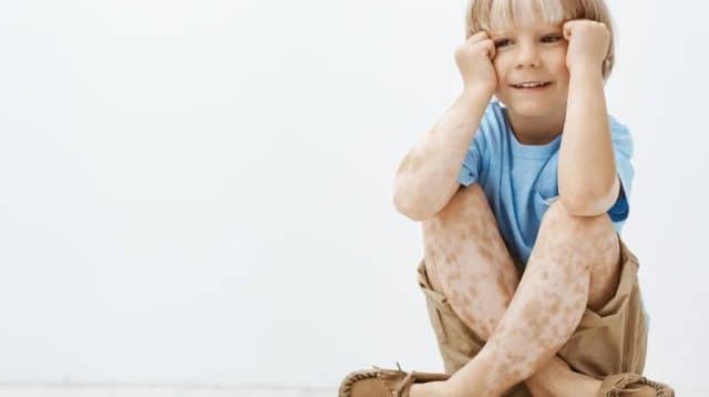 Xeroderma Pigmentosum
