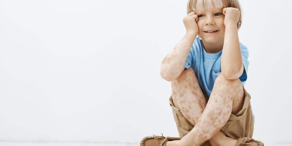 Xeroderma Pigmentosum