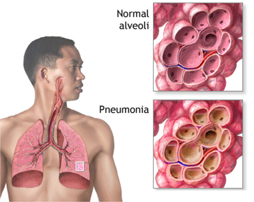 Pneumonia