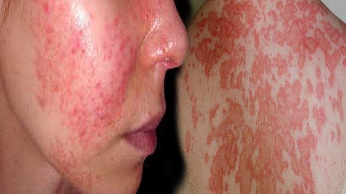 Systemic Lupus Erythematosus