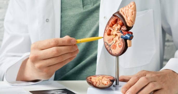 Illustration Urinary Stones