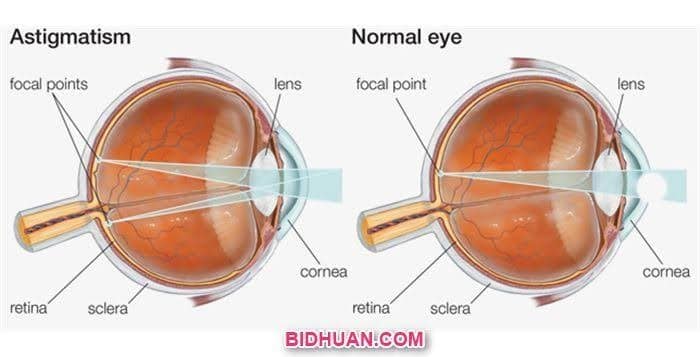 astigmatism