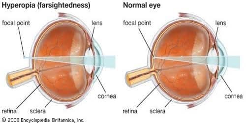 hyperopia vs normal eye