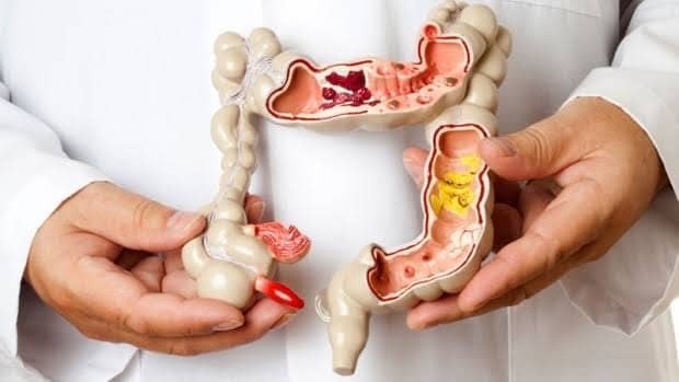 Inflammatory Bowel Disease