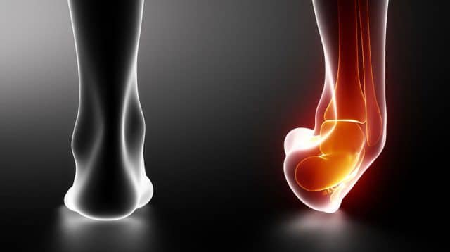 sprain ankle