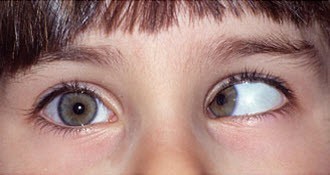 strabismus