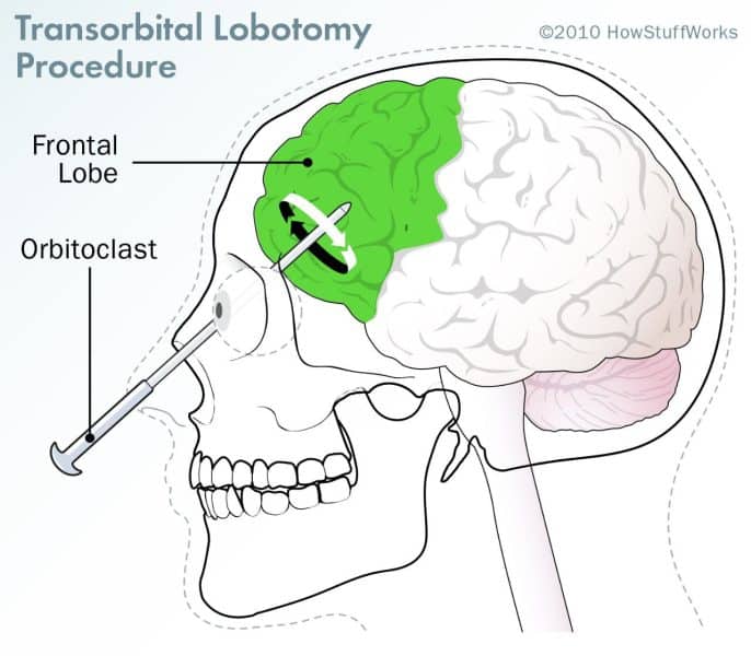 transorbital lobotomy procedure