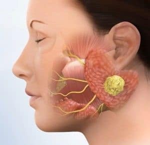 Gambar Tumor Colli Gambar Tumor Colli