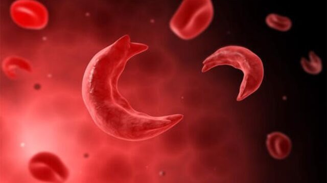 Anemia Sel Sabit