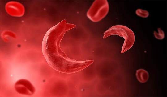Anemia Sel Sabit
