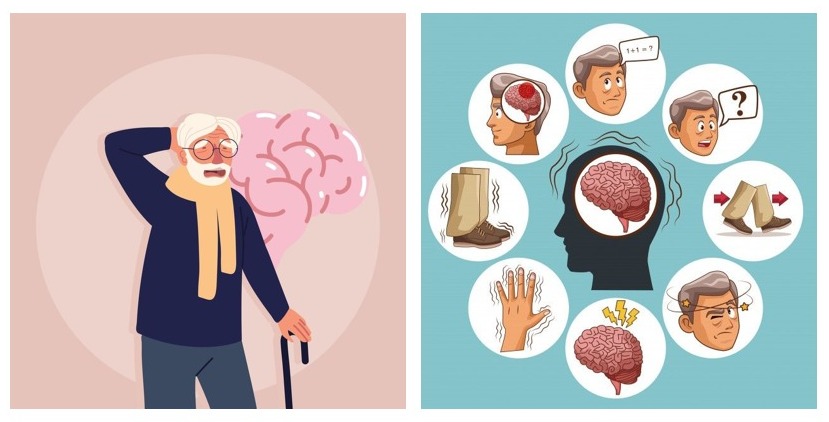 Neurodegenerasi Alzheimer