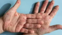 Penyakit Mpox