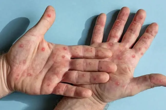 Penyakit Mpox