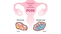 Dampak Polycystic Ovary Syndrome (PCOS) terhadap Pola Makan dan Aktivitas Fisik pada Wanita Usia Subur