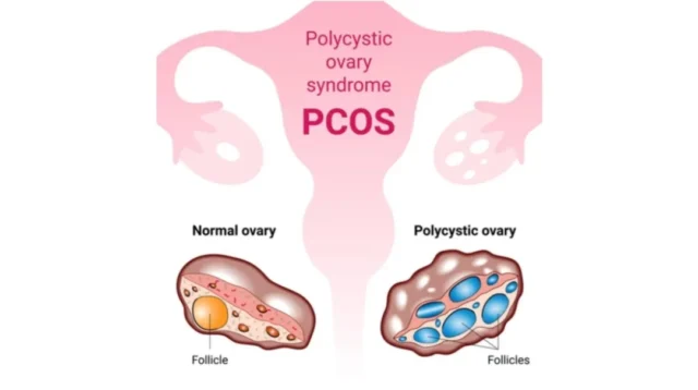 Dampak Polycystic Ovary Syndrome (PCOS) terhadap Pola Makan dan Aktivitas Fisik pada Wanita Usia Subur